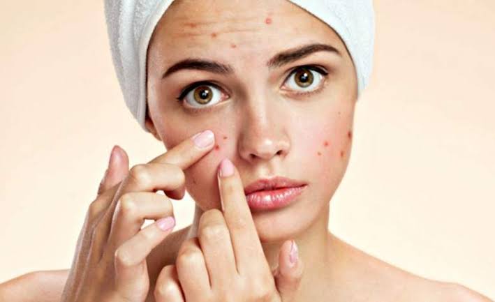 Acne: trending topic do Twitter