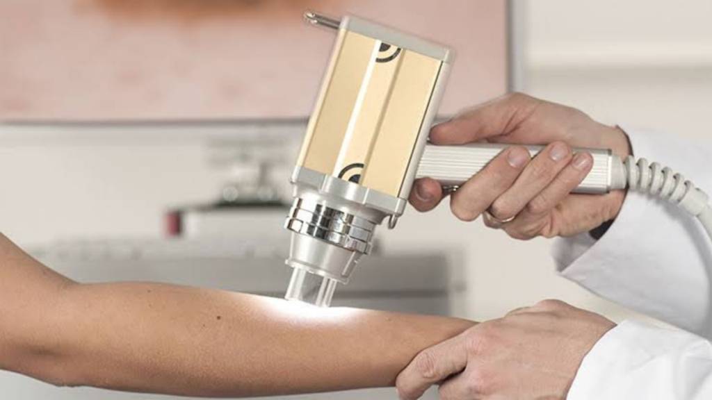 Melanoma e o mapeamento das pintas