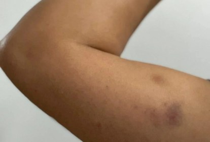 Foto mostra braço com hematomas