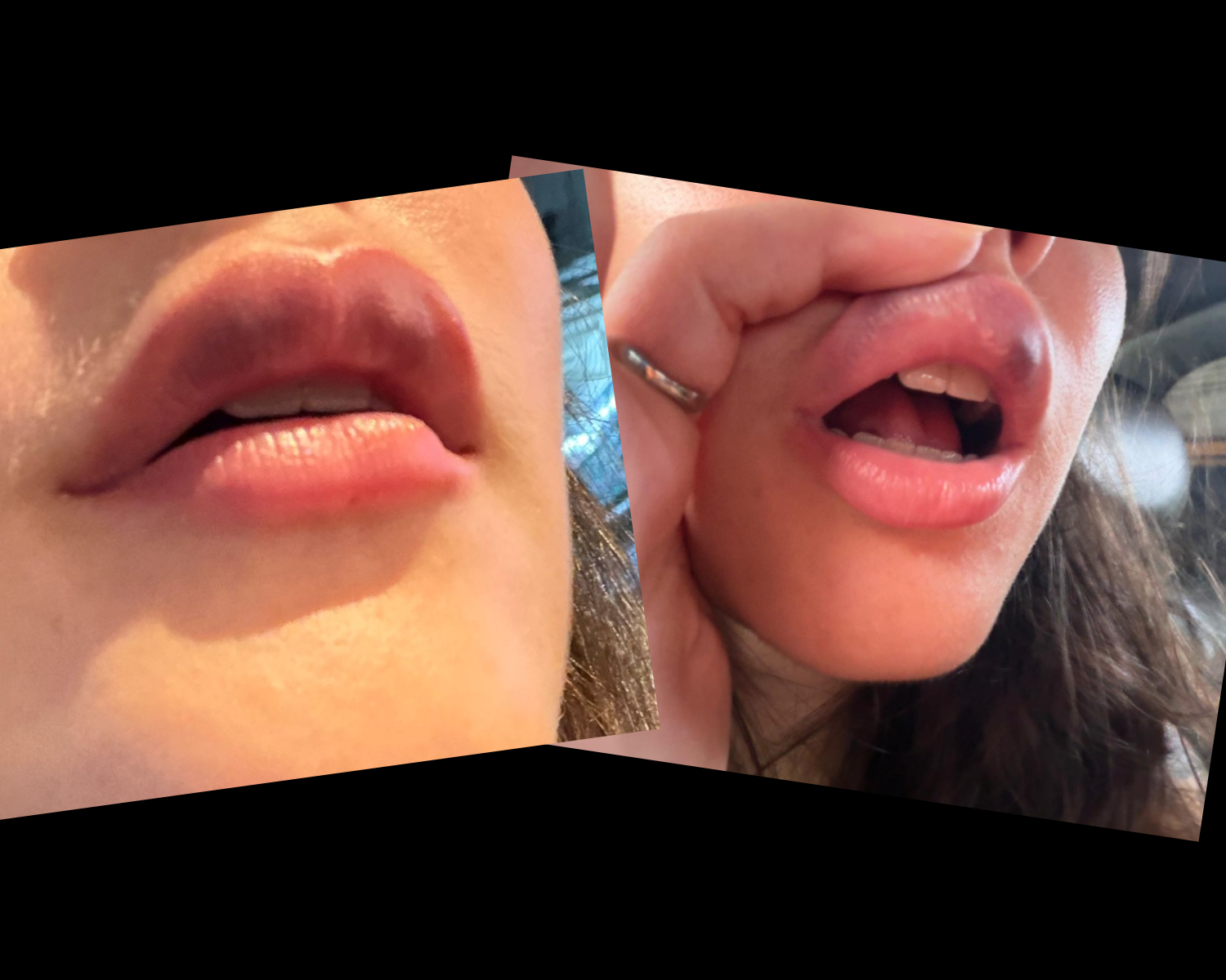 Se você fez preenchimento labial, cuidado com os beijos calientes…